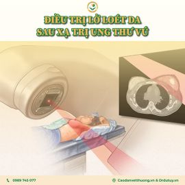 HƯỚNG DẪN ĐIỀU TRỊ LỞ LOÉT DA SAU XẠ TRỊ UNG THƯ VÚ