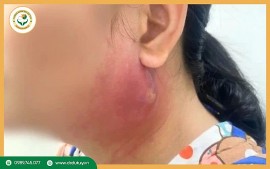 Hướng Dẫn Nhận Biết Sớm Mụn Nhọt Bị Nhiễm Trùng Để Tránh Biến Chứng Nguy Hiểm