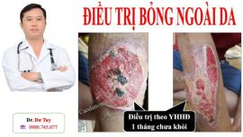 Hướng dẫn sử dụng Cao dán điều trị bỏng bô loét da