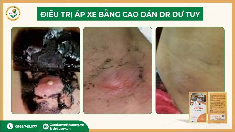 ket-qua-dieu-tri-ap-xe-bang-cao-dan