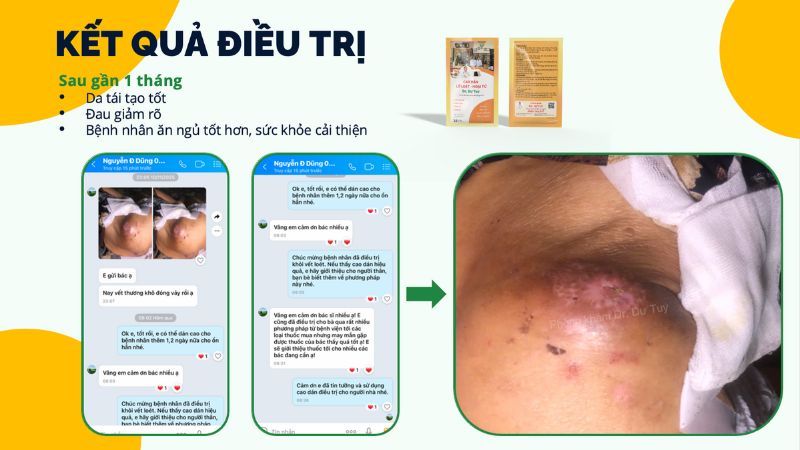 ket-qua-dieu-tri-loet-ty-de-1-thang