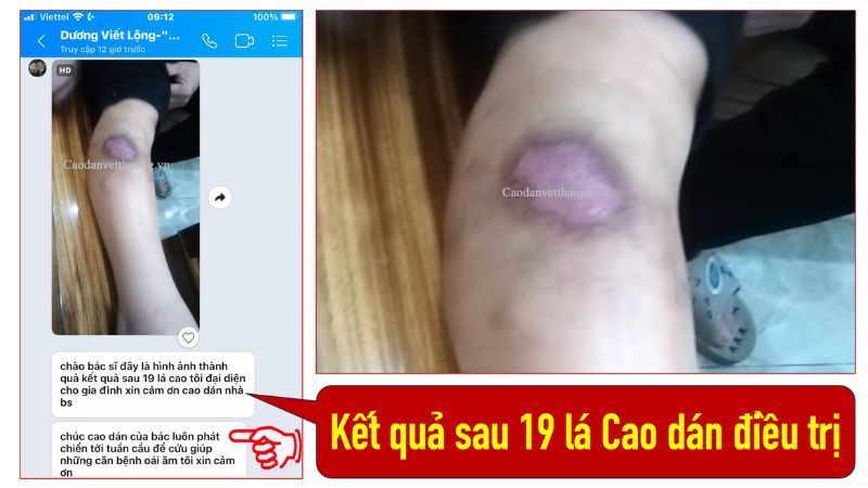 kết quả sau 19 lá cao