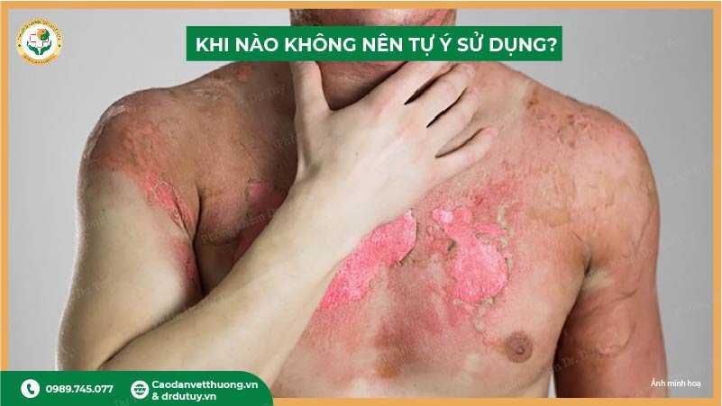 khi nào không nên tự ý sử dụng cao dán trị bỏng