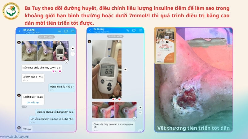 kiem-soat-duong-huyet-dieu-tri-vet-thuong-got-chan-tieu-duong