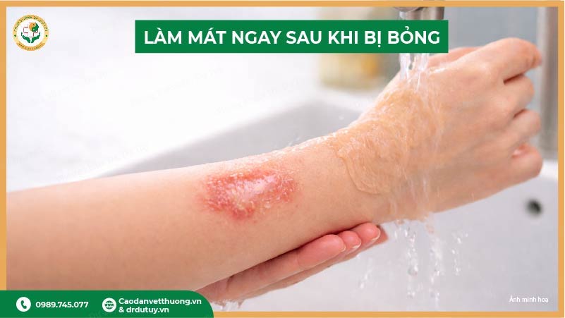 làm mát ngay sau khi bị bỏng nước sôi