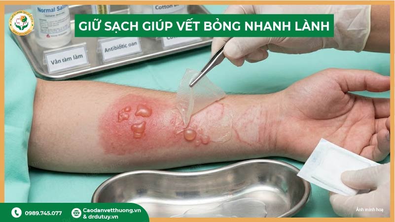 làm sạch vết bỏng đúng cách