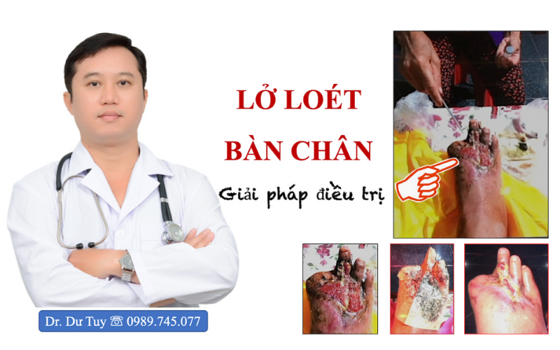 Lở loét bàn chân giải pháp điều trị