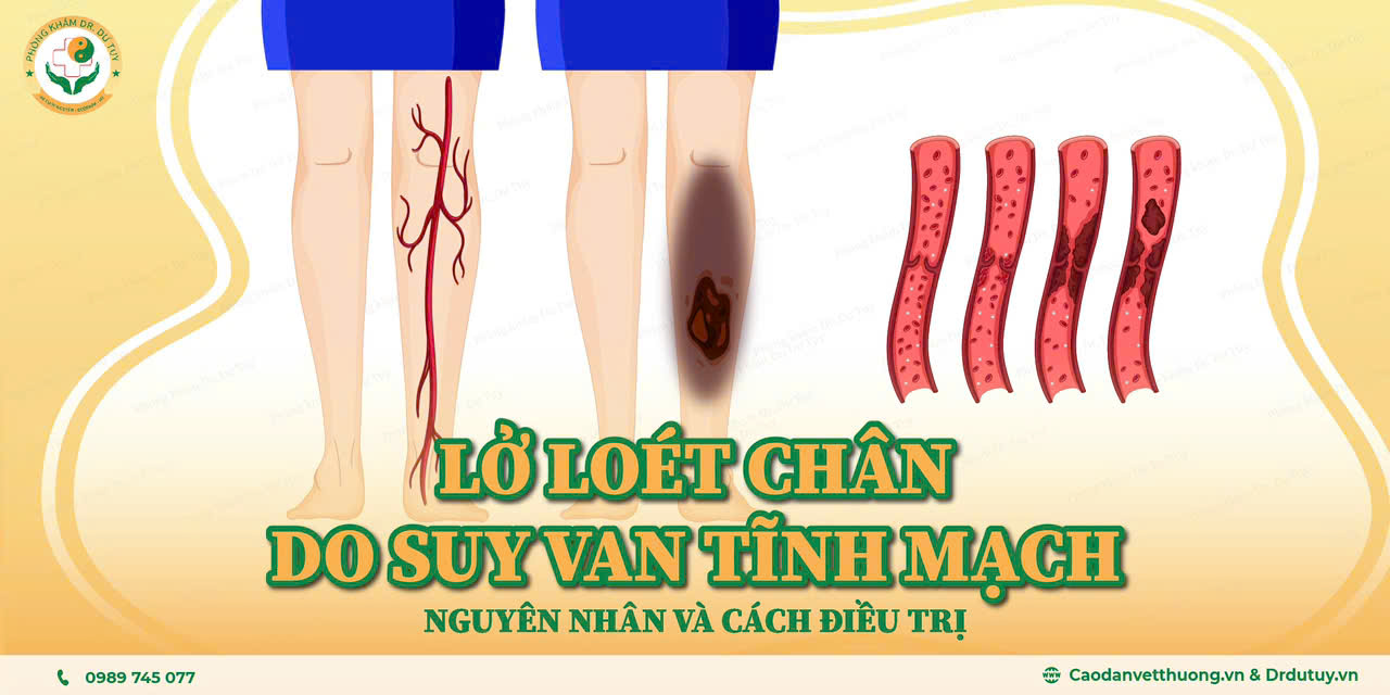 lo-loet-chan-do-suy-van-tinh-mach8