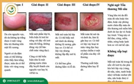 Lở Loét Da Do Nằm Lâu: Các Giai Đoạn Tiến Triển Và Cách Phòng Tránh Hiệu Quả