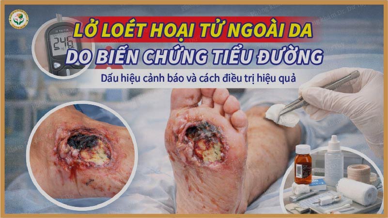 lo-loet-hoai-tu-ngoai-da-do-tieu-duong