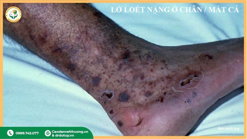 lo-loet-hoai-tu-ngoai-da-o-nguoi-cao-tuoi