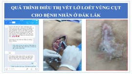 Điều trị lở loét vùng cùng cụt cho bệnh nhân ở Đắk Lắk