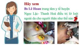 Hãy xem bác sỹ Lê Hoan trung tâm y tế huyện Ngọc Lặc- Thanh Hoá điều trị lở loét ngoài da cho người thân như thế nào?
