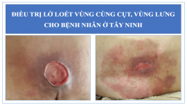 Điều trị lở loét vùng cùng cụt, vùng lưng cho bệnh nhân ở Tây Ninh