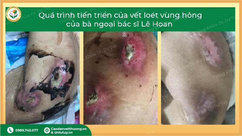 lo-loet-vung-hong-nguoi-cao-tuoi-giai-doan-dau