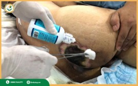 Lở loét vùng mông: Dấu hiệu cảnh báo và cách điều trị đúng cách