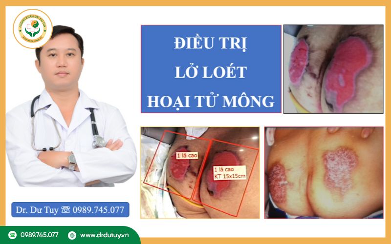 lo-loet-vung-mong-nguyen-nhan-giai-phap-cham-soc-dieu-tri-hieu-qua-tai-nha5