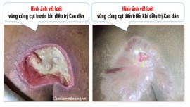 Loét áp lực ở vùng xương cụt