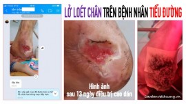 Loét chân do tiểu đường