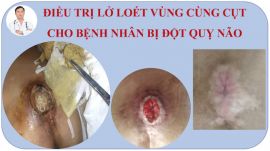 Loét cùng cụt lâu ngày chữa khỏi nhờ Cao dán gia truyền