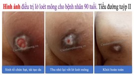 Loét da ở người già có những dấu hiệu nào?