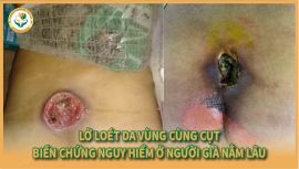 Loét da ở người nằm liệt lâu ngày