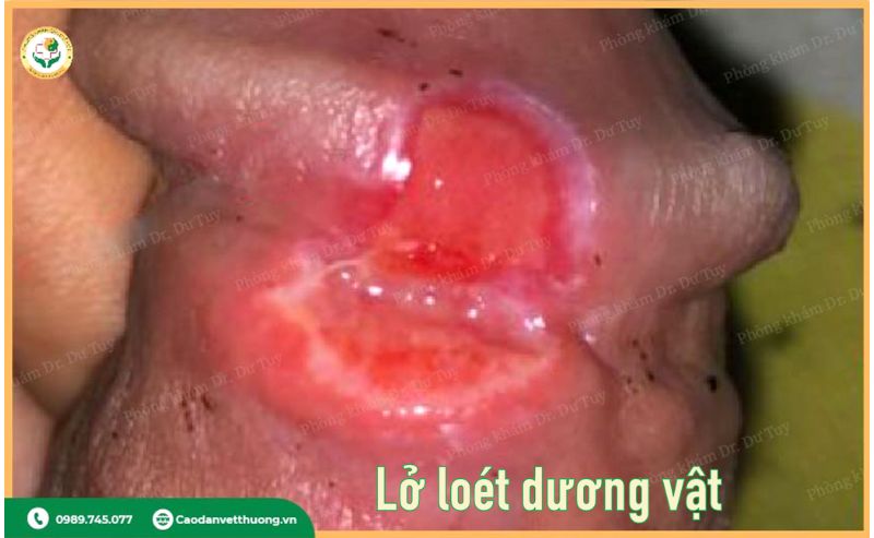 loét dương vật