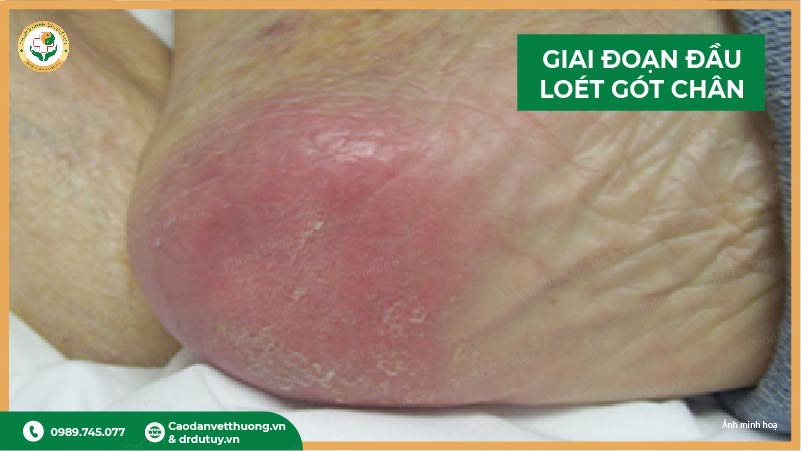 loet-got-chan-giai-doan-dau