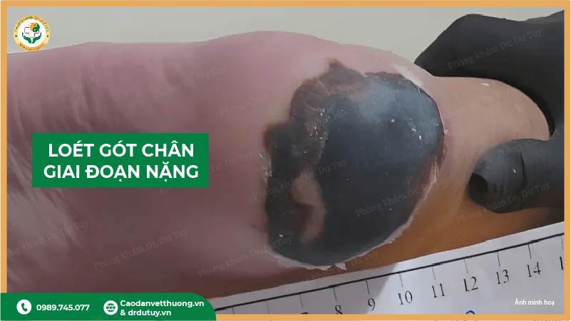 loet-got-chan-giai-doan-nang