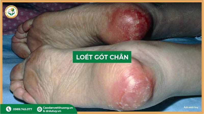 loet-got-chan-giai-doan-nhe