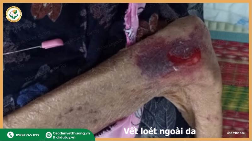 loet-got-chan-o-nguoi-nam-lau