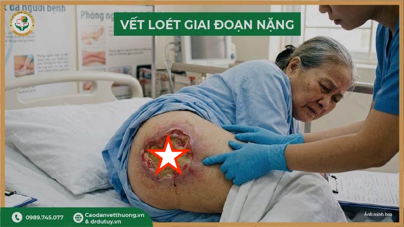 loet-ti-de-giai-doan-nang