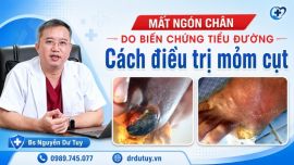 Nguy Cơ Cắt Cụt Ngón Chân Do Tiểu Đường: Cách Chăm Sóc Và Điều Trị Mỏm Cụt Đúng Cách