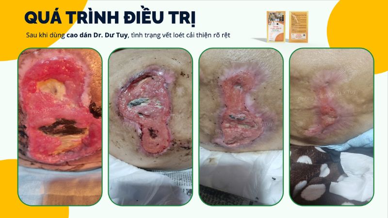 miếng dán đông y trị lở loét