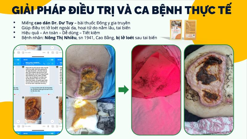 miếng dán trị loét da tại nhà