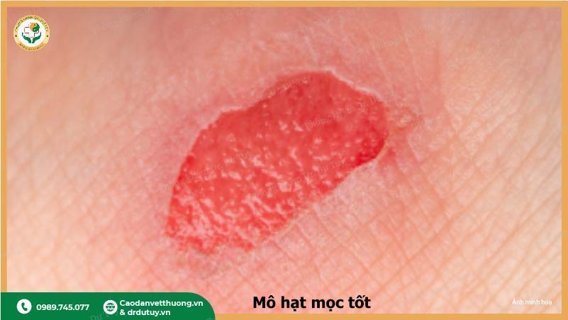 mo-hat-trong-qua-trinh-lanh-vet-loet