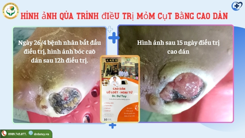 mom-cut-sau-15-ngay-cham-soc