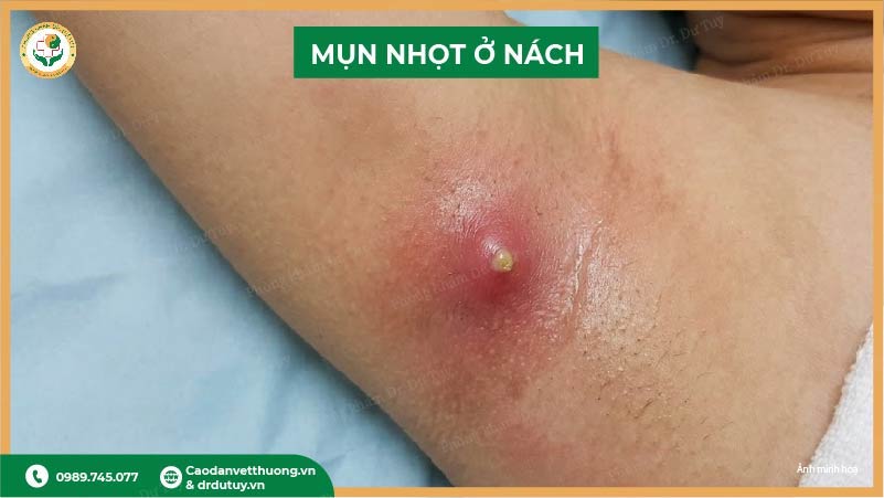 mun-nhot-o-nach-sung-to-dau-nhuc-phai-lam-sao-de-nhanh-khoi