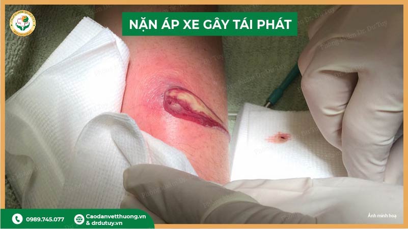 nan-ap-xe-sai-cach