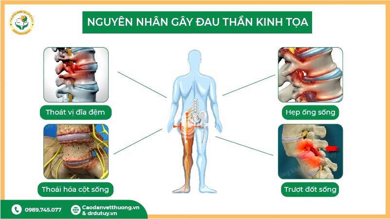 nguyen-nhan-gay-dau-than-kinh-toa-thoat-vi-dia-dem