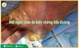 Nguyên Nhân Gây Hoại Tử Ngón Chân Ở Người Cao Tuổi