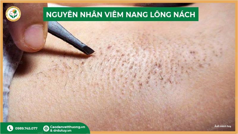 nguyen-nhan-viem-nang-long-nach