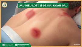 Nhận diện sớm các dấu hiệu hoại tử do loét tì đè ở bệnh nhân nằm lâu