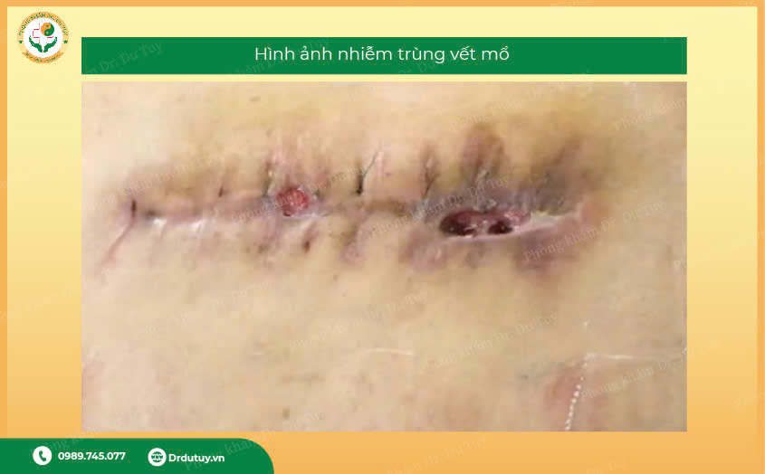 nhiem-trung-vet-mo-13