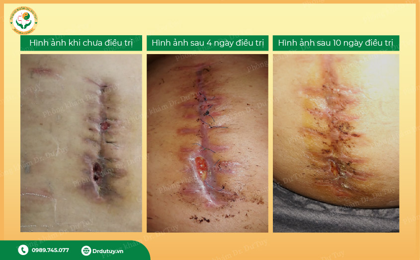 nhiem-trung-vet-mo-4