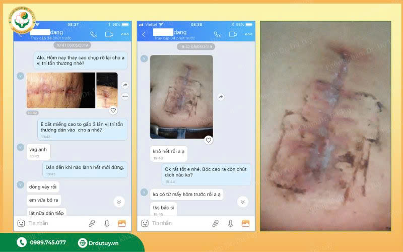 nhiem-trung-vet-mo-5
