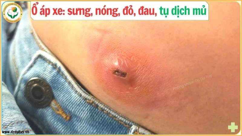 o-ap-xe-ngoai-da-sung-nong-do-dau-tu-mu(1)