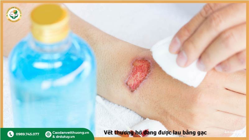 oxy-gia-lam-lau-lanh-vet-thuong