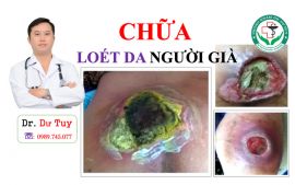 Điều trị hoại tử lở loét da tại Nam Định