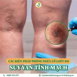 Phòng ngừa lở loét do suy van tĩnh mạch